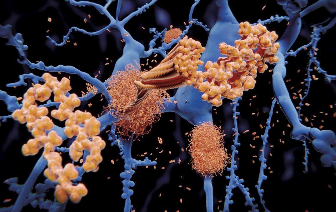 Estudo identifica forma rara de Alzheimer, adquirida por tratamento em desuso